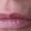 Mehr Volumen am Lippenrand durch Unterspritzung