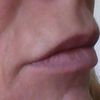 Mehr Volumen am Lippenrand durch Unterspritzung