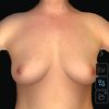 Wer hat Erfahrung mit Implantaten über dem Brustmuskel?