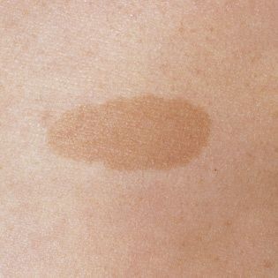 Leberfleck auf Rücken entfernen oder bleichen?