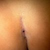 Loch in der Narbe nach Po Vergrößerung mit Implantaten