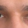 Asymmetrische Augen/Augenhöhlen: Welcher Eingriff hilft?