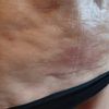 Dellen und Verfärbungen acht Wochen nach Fettabsaugung, was tun?