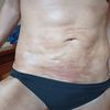 Dellen und Verfärbungen acht Wochen nach Fettabsaugung, was tun?