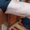 Dellen und Verfärbungen acht Wochen nach Fettabsaugung, was tun?