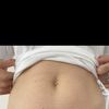 Dellen nach Fettabsaugung am Unterbauch
