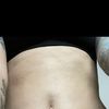 Dellen nach Fettabsaugung am Unterbauch