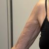 Oberarmstraffung nicht zufrieden