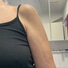 Oberarmstraffung nicht zufrieden