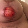 Brustvergrößerung - Spürbares Implantat, Loch in der Brust, Erfahrungen?