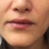 Suche Spezialisten für dauerhafte Lippenvergrößerung 