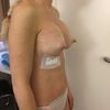 Implantate komisch hoch 9 Tage post Brustvergrößerung mit 365 cc rund high