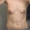 Brustvergrößerung von 70A auf B mit anat. 225 ml, 170 cm, 53 kg