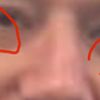 Fettpolster unter Augen - was kann man da tun?