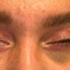 Augenlid-Op, zuviel Haut entfernt, was tun, welche Alternativen gibt es?