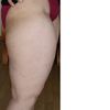 Liposuktion an Oberschenkeln nach Abnahme von 30 kg, 167 cm, 70 kg