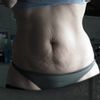 Ernüchterung nach Slimlipo - Korrekturmöglichkeit?