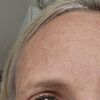 Oberlidstraffung trockene augen