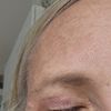 Oberlidstraffung trockene augen