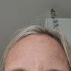 Oberlidstraffung trockene augen