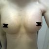 Können sich Brüste mit PU Implantaten (UBM) noch verändern??
