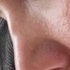 Unebenheit nach Nasennachkorrektur mit Knorpeltransplantation