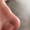 Unebenheit nach Nasennachkorrektur mit Knorpeltransplantation