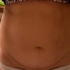 Reicht Liposuction oder ist Bauchdeckenstraffung effektiver?