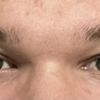 Asymmetrische Augenpartie