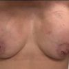 Implantate rutschen beim anspannen nach oben
