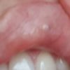 Lippenvergrößerung mit Juverderm - Blauer Punkt in der Lippe
