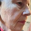 Falten Behandlung für 85 jährige