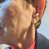 Falten Behandlung für 85 jährige