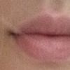 Lippen mit Hyaluron formen?