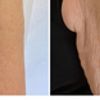 solare Elastose, Photoaging, Hautalterung, Sonnenschaden, Volumenverlust, Falten