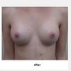 Welche Implantatgröße ist die richtige für mich? Motiva Ergonomix 245cc für ein volles B/ kleines C Körbchen?
