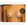Welche Implantatgröße ist die richtige für mich? Motiva Ergonomix 245cc für ein volles B/ kleines C Körbchen?