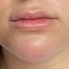 Lippenunterspritzung mit Juvederm - Ist Hyaluron verrutscht?