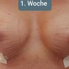 Kompressions BH und Stuttgarter Gurt
