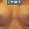 Kompressions BH und Stuttgarter Gurt