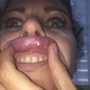 Granulome von Lippenvergrößerung mit Hyaluronsäure vor 3 Monaten