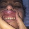Granulome von Lippenvergrößerung mit Hyaluronsäure vor 3 Monaten