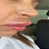 Lippenunterspritzung - Haut zwischen Lippe und Nase angeschwollen, normal?