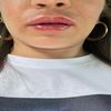 Lippenunterspritzung - Haut zwischen Lippe und Nase angeschwollen, normal?