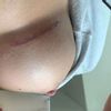Blase an Narbe nach Brustop, kommt das vom Narbenpflaster?