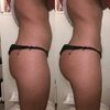 Brazilian Butt Lift mit Eigenfett und Modellierung durch Vaser Liposuktion