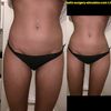 Brazilian Butt Lift mit Eigenfett und Modellierung durch Vaser Liposuktion