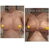 Total andere Form und Größe nach Brustvergrößerung mit anat. 445 cc Impl.