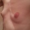 Welche Implantatgröße bei Brustvergrößerung von 70AA auf B/C mit 245 oder 280 ml?