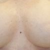 4 Wochen Post OP kein Abschwellen ?